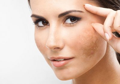 Laser Treatment for Acne