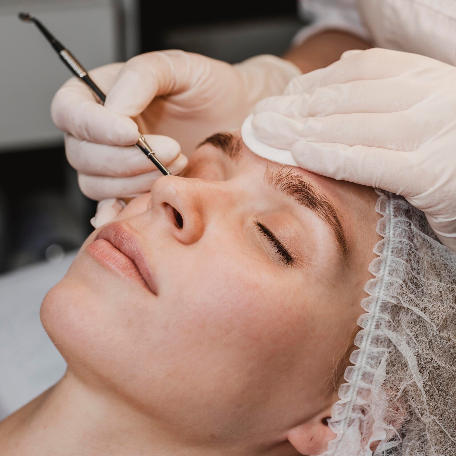 Acne and pigmentation treatment result - Mumbai dermatology clinic